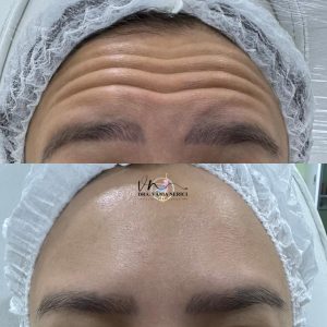 botox (1)