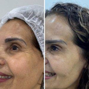 botox (3)