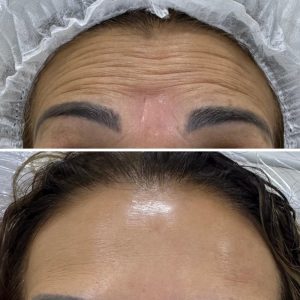botox (7)