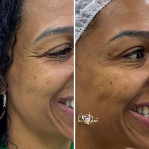 botox (8)