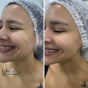 botox (9)